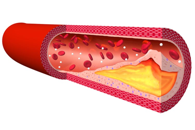 脂質異常症イメージ